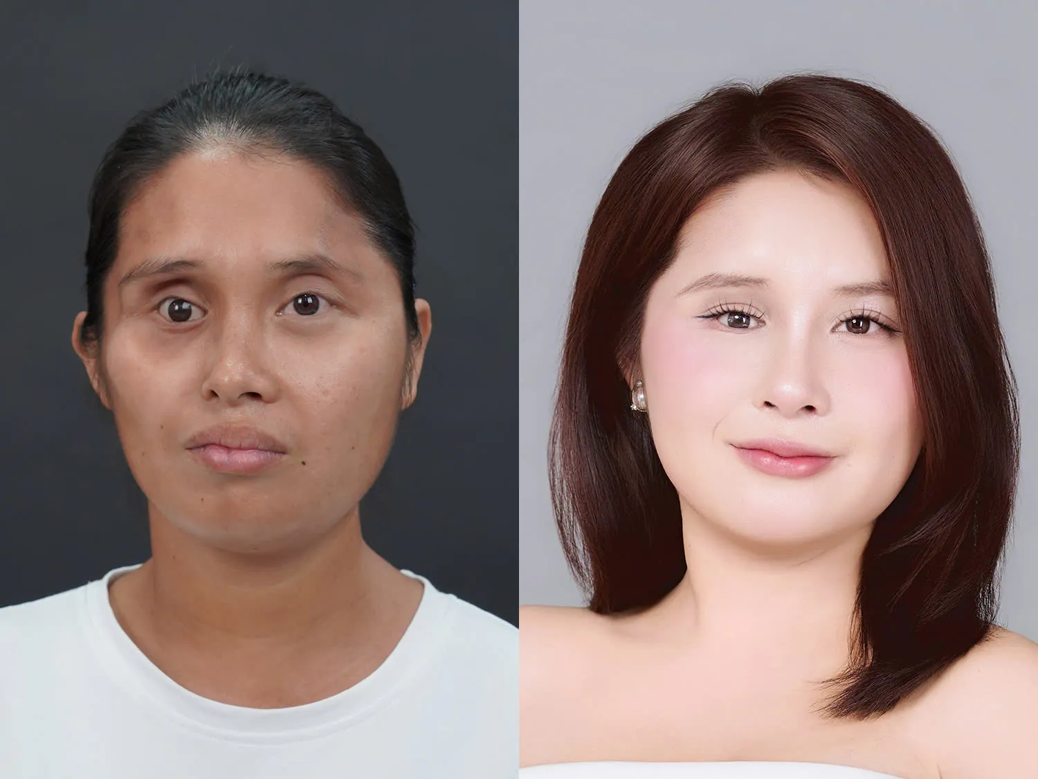 Hình ảnh so sánh Before/After của một thí sinh HTLX nổi bật kèm theo timeline hồi phục (7 ngày - 30 ngày - 6 tháng).