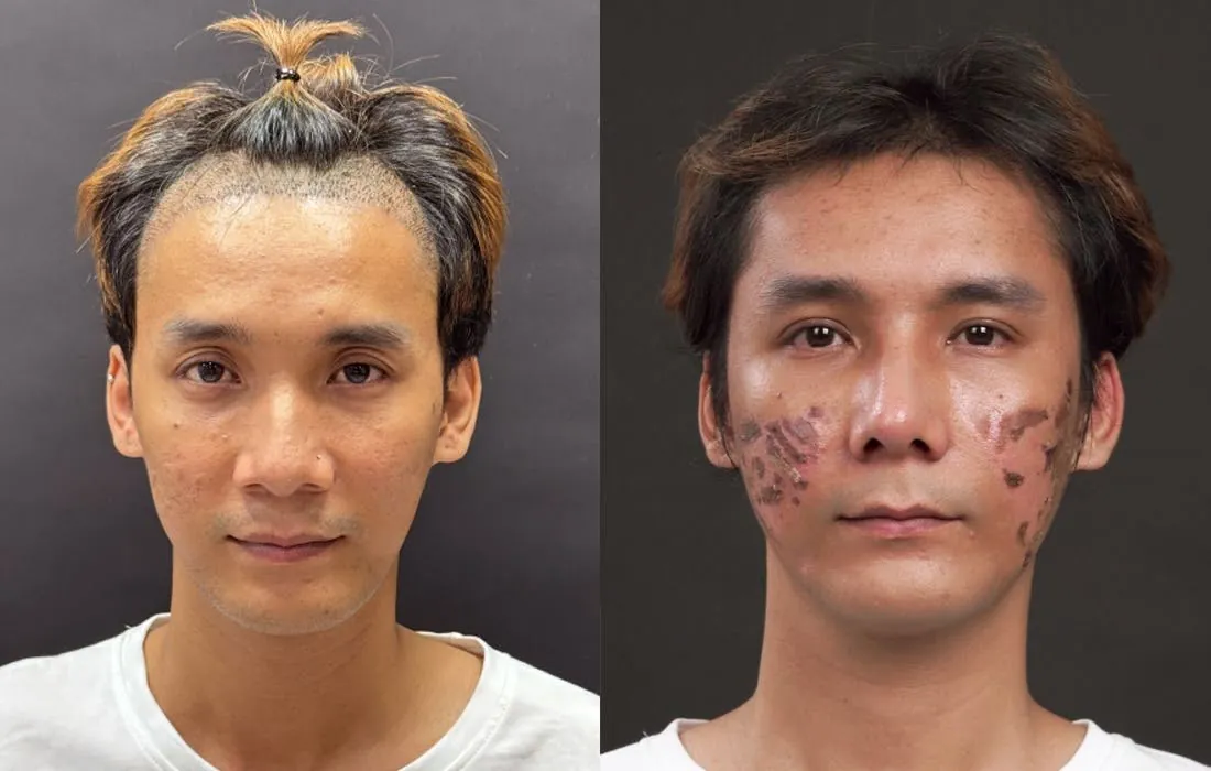 Chí Nguyện hoàn thiện với cấy tóc, trị sẹo, nâng mũi, cắt mí, cấy mỡ mặt