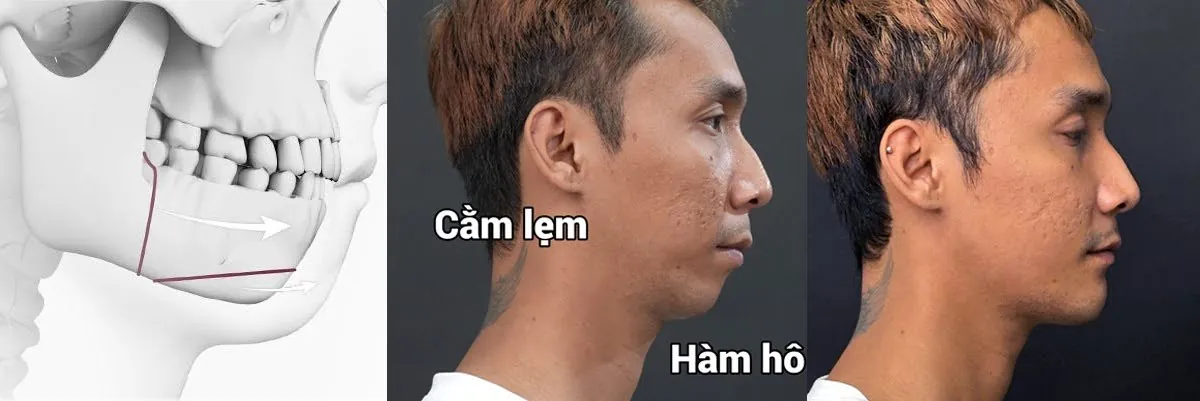 Lê Chí Nguyện sau chỉnh hàm hô & trượt cằm