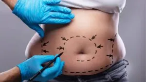Quy trình giảm mỡ Zero Fat 9 bước an toàn tại Bệnh viện Kangnam