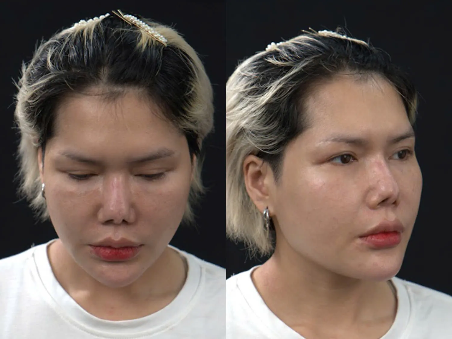 Mũi của Quỳnh Mai bị tổn thương sau 5 lần sửa mũi