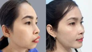 Sau 30 ngày chỉnh hàm hô 3D và trượt cằm khách hàng Trần Thị Loan lột xác ngoạn mục