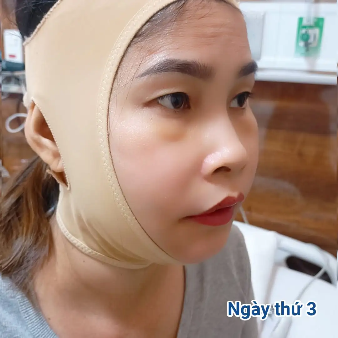 Sau 3 ngày chị Loan đeo hàm duy trì, sức khỏe ổn định và đã được xuất viện