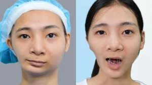 60 ngày khắc phục hàm “lượn sóng” của Nguyễn Thị Diệu tại Kangnam