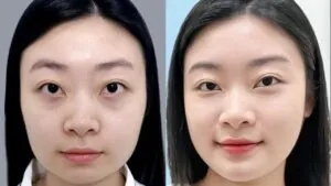Tạm biệt hàm vuông to bạnh sau 14 ngày của Yến Nhi tại Kangnam Hà Nội