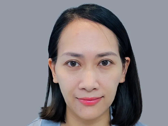 Chị Thanh Trà gặp khuyết điểm má hóp, thái dương lõm