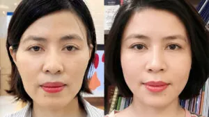 Sau 7 ngày cấy mỡ tự thân Matrix 3D chị Thanh Nhàn trẻ hóa gương mặt toàn diện