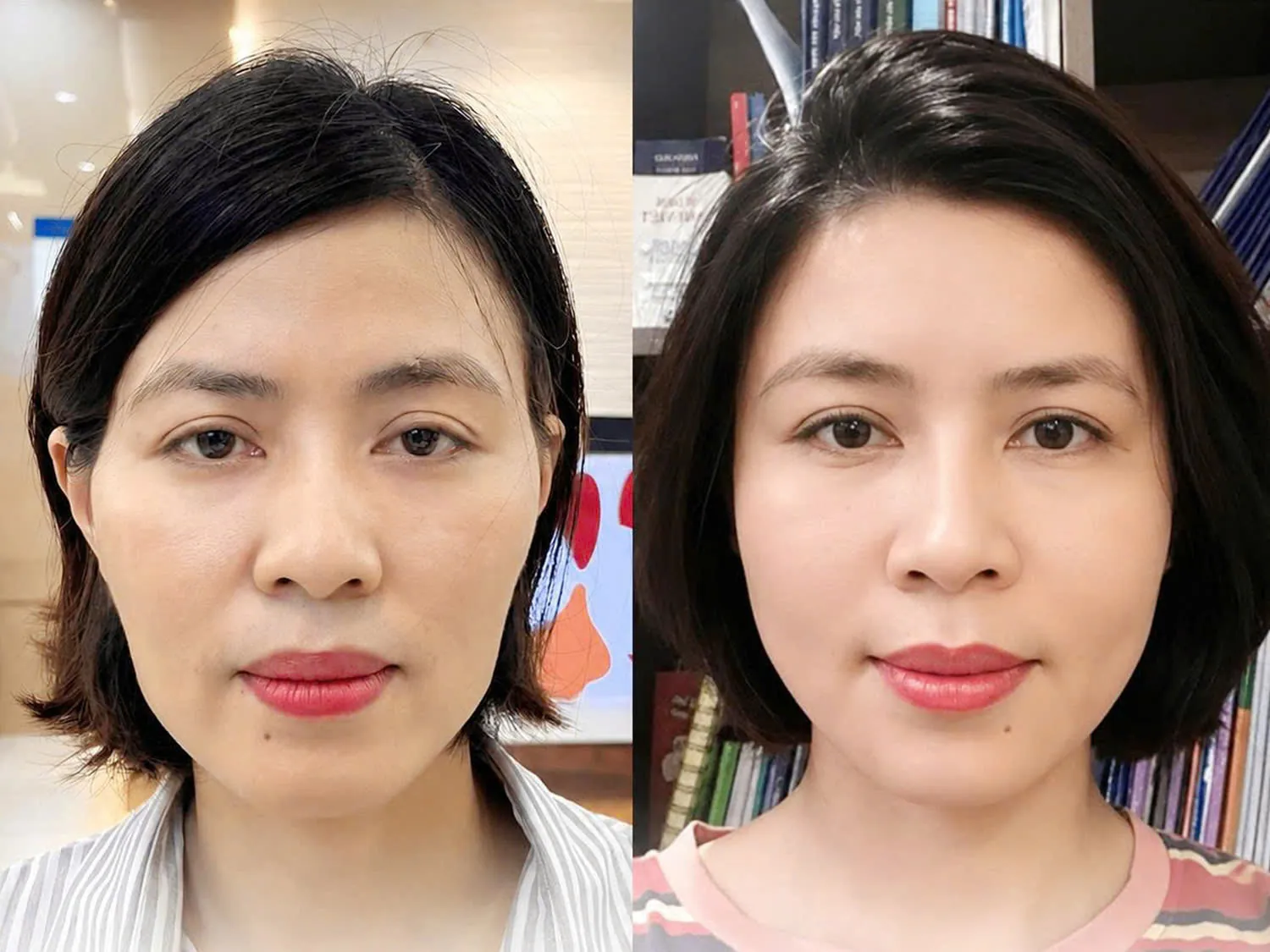 Chị Nhàn trẻ ra 5 tuổi sau khi cấy mỡ mặt tại Kangnam