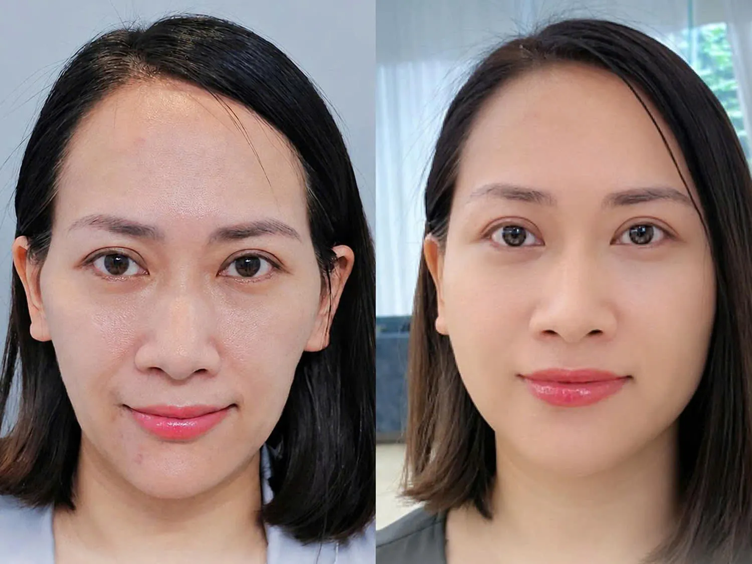 Chị Trà sở hữu gương mặt đầy đặn, cân đối sau cấy mỡ Matix 3D