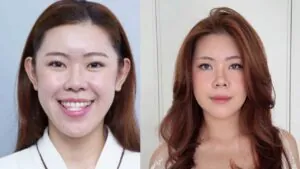 Tiktoker Đông Có Anh “lột xác” sau chỉnh hàm móm tại Kangnam Hà Nội