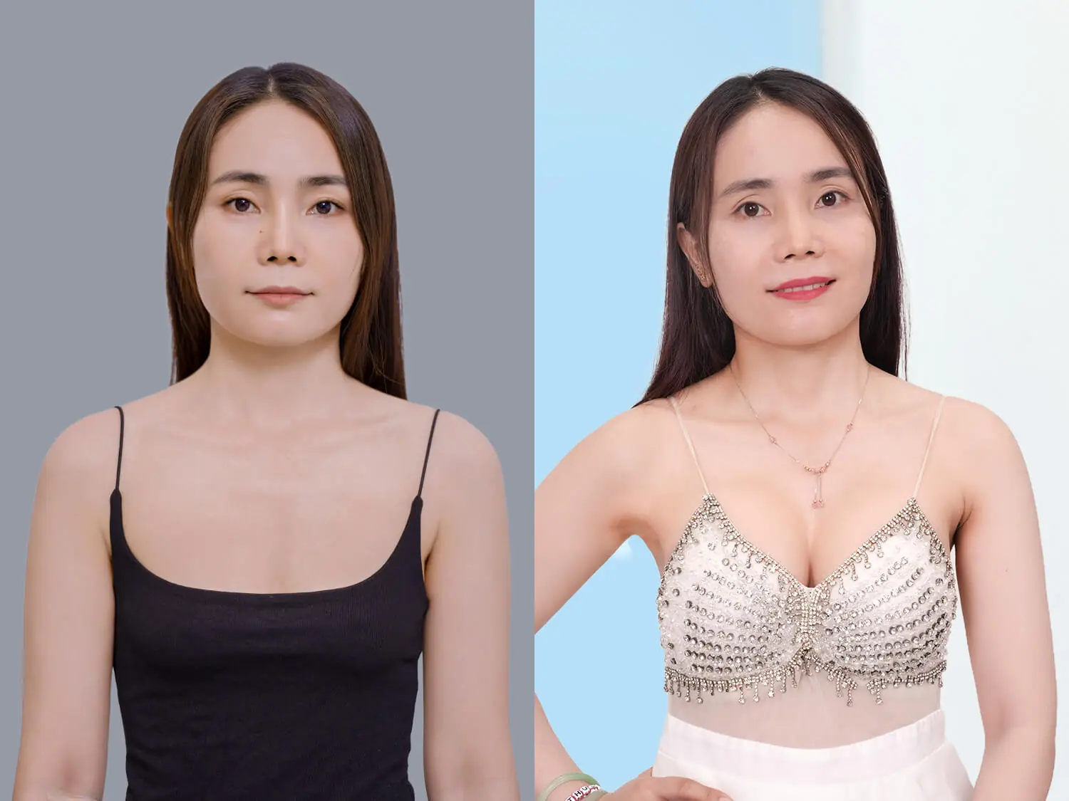 Nâng ngực 6D SmoothSilk Pro giúp khách hàng khắc phục ngực nhỏ teo lép, mang lại vòng một to tròn, quyến rũ