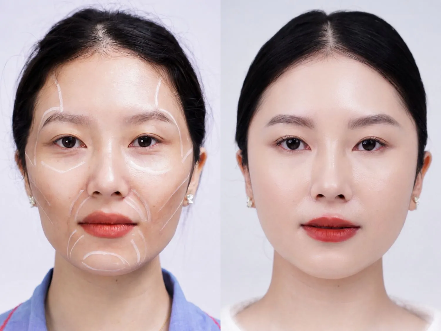 Chất lượng làn da sau cấy mỡ đa tầng Matrix 3D tươi trẻ, mềm mịn và căng bóng hơn