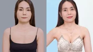 Sau 14 ngày nâng ngực 6D không chạm, mẹ 2 con Thúy Nguyễn tìm lại vòng một căng tròn, tự nhiên