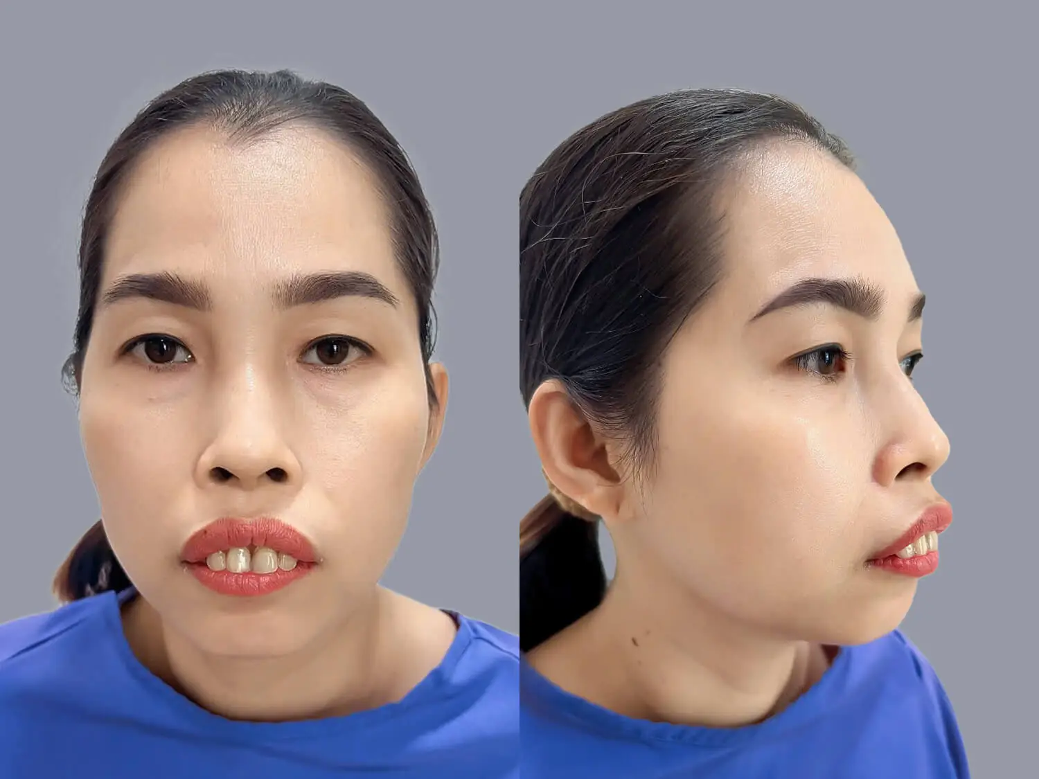 Chị Loan gặp tình trạng hàm trên nhô ra phía trước nhiều, miệng không khép kín được, cằm thiếu hụt