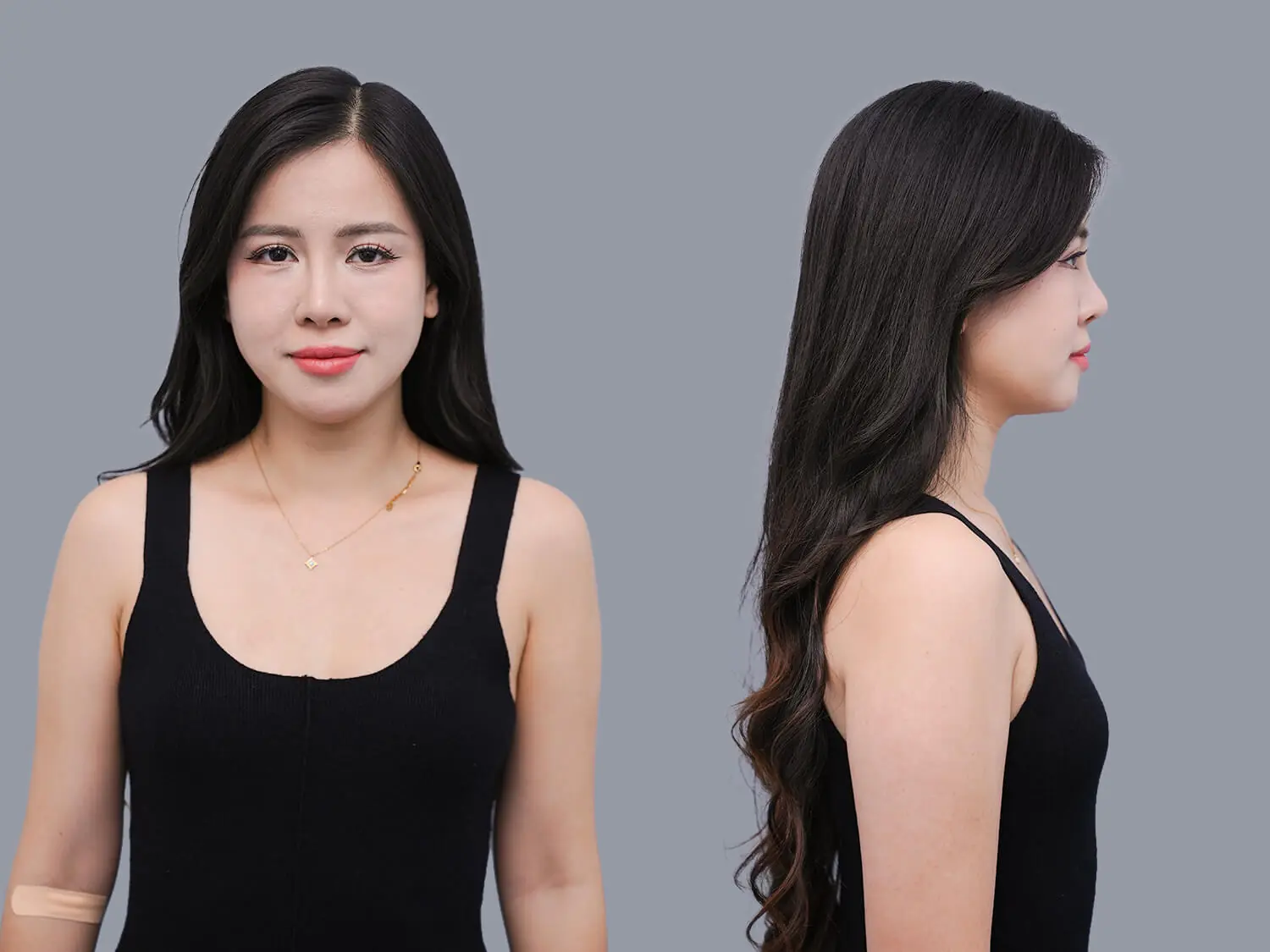 Hoàng Yến gặp tình trạng ngực nhỏ, thiếu mô tuyến