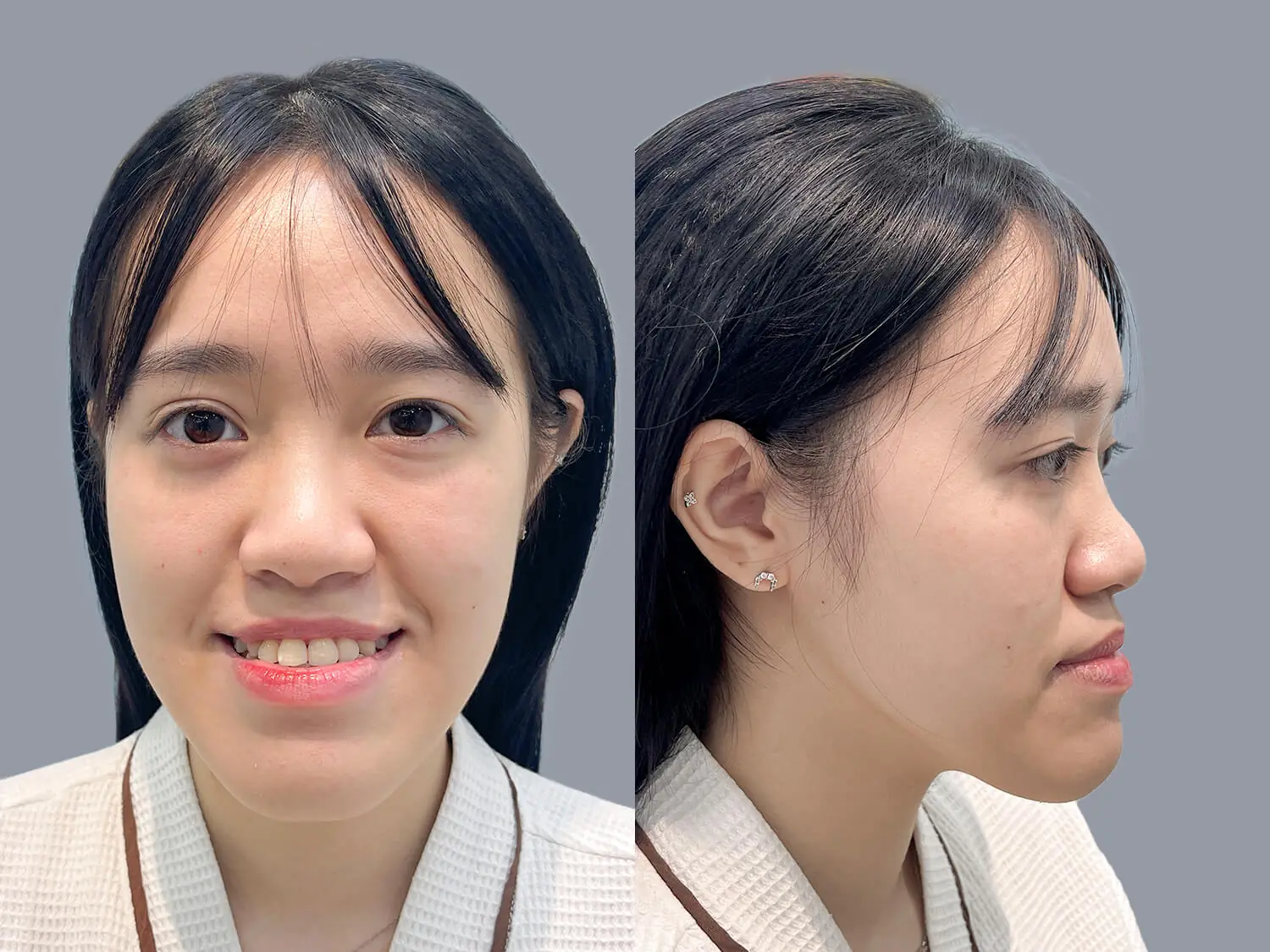 Thùy Linh gặp tình trạng hàm dưới phát triển quá mức, khớp cắn ngược