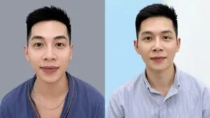 Sau 14 ngày khắc phục thái dương hõm má hóp bằng cấy mỡ Biofat cho khách hàng Việt kiều Pháp
