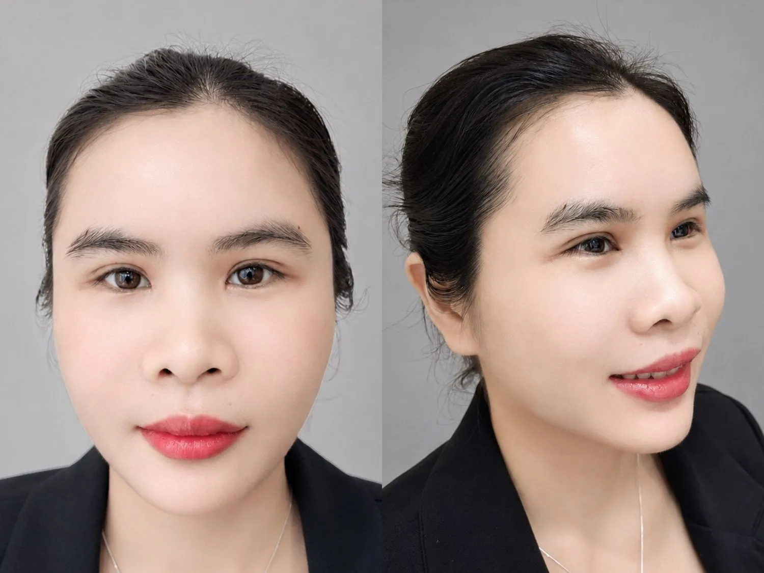 Sau cấy mỡ khuôn mặt chị Tỉnh đã đầy đặn, tròn đầy và mịn màng hơn