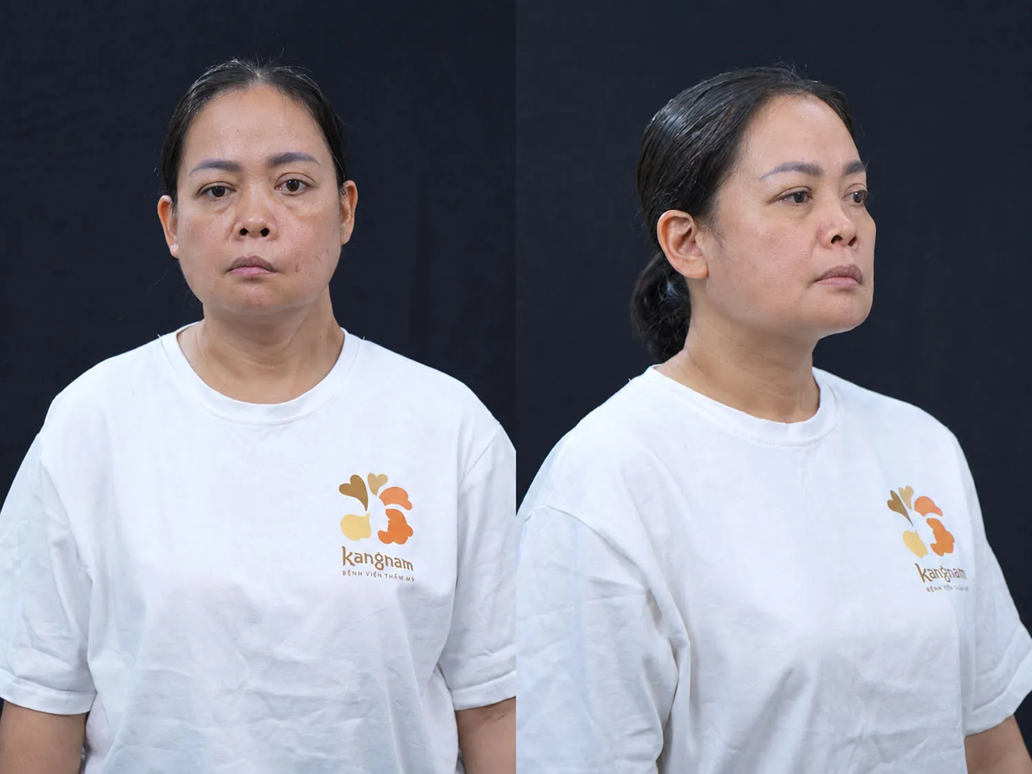 tình trạng liệt dây thần kinh của Bạch Tuyết