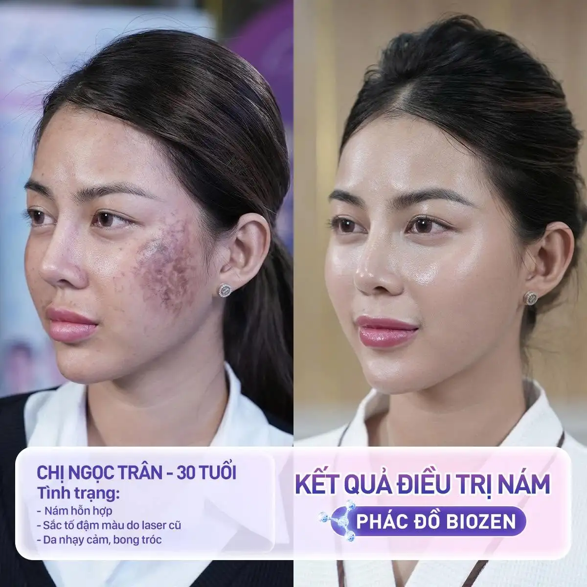Cùng nhìn lại bức ảnh so sánh kết quả sau khi trị nám của Trân