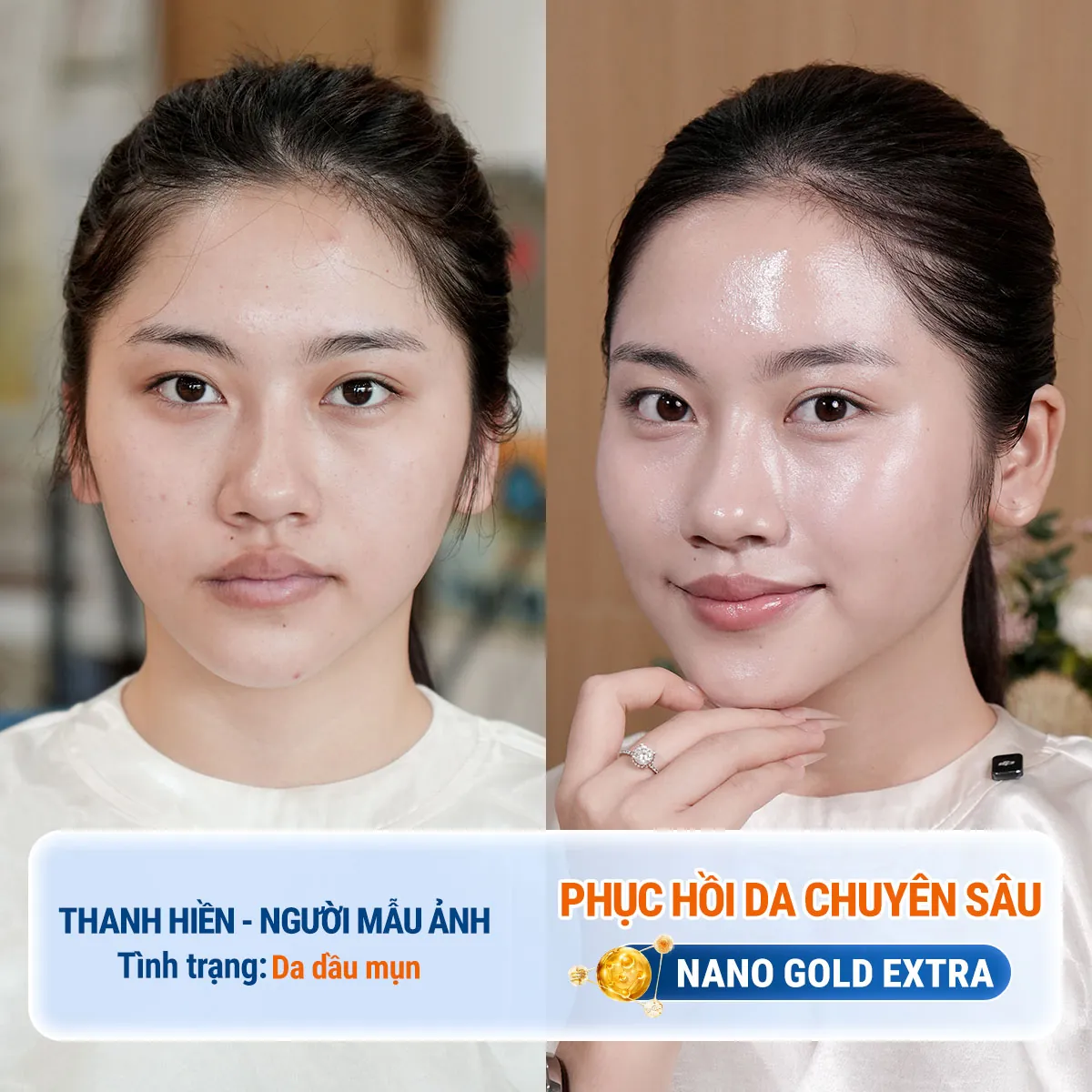 Làn da của Thanh Hiền như được phục hồi và tái tạo mạnh mẽ sau khi kết thúc liệu trình, da bóng khỏe