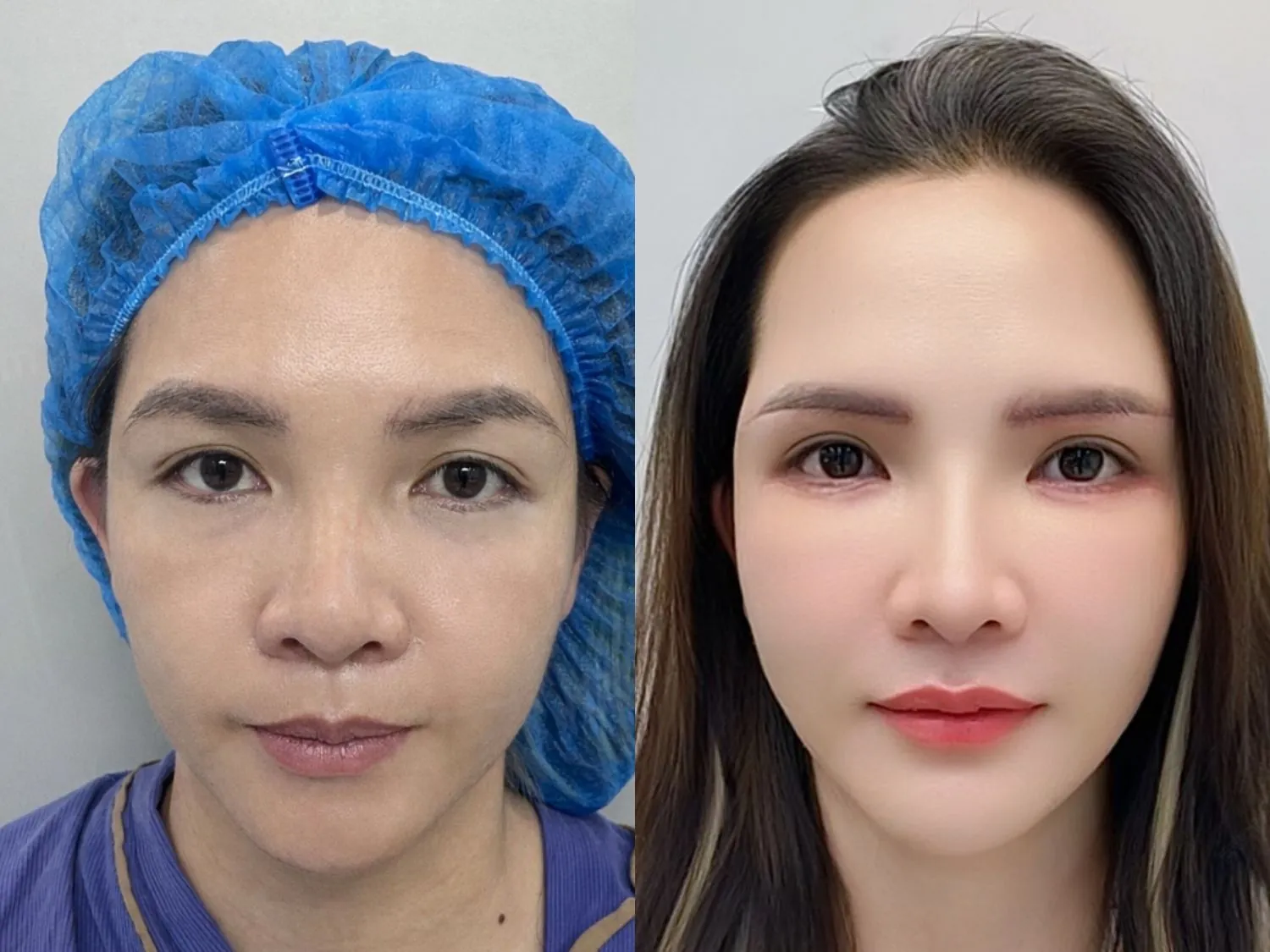 Khách hàng Ngọc Vân sở hữu đôi mắt và chân mày cân đối sau treo chân mày