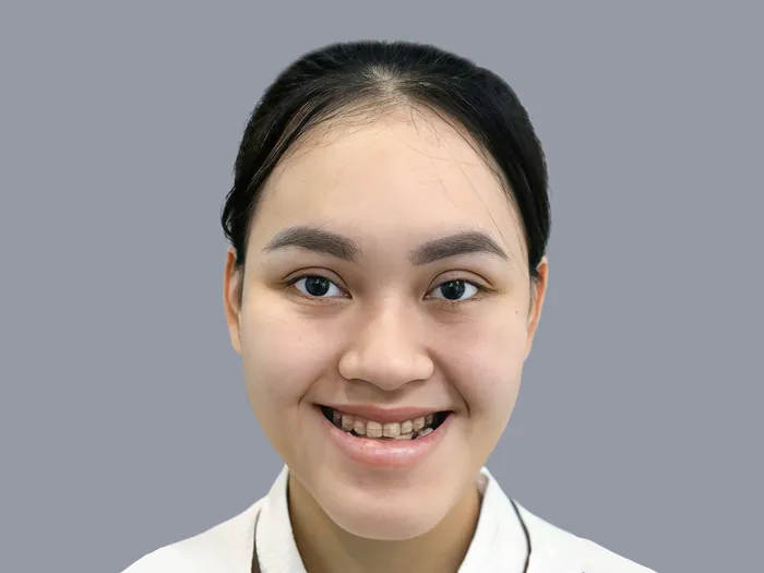 tình trạng khách hàng khuôn hàm lệch, gò má cao
