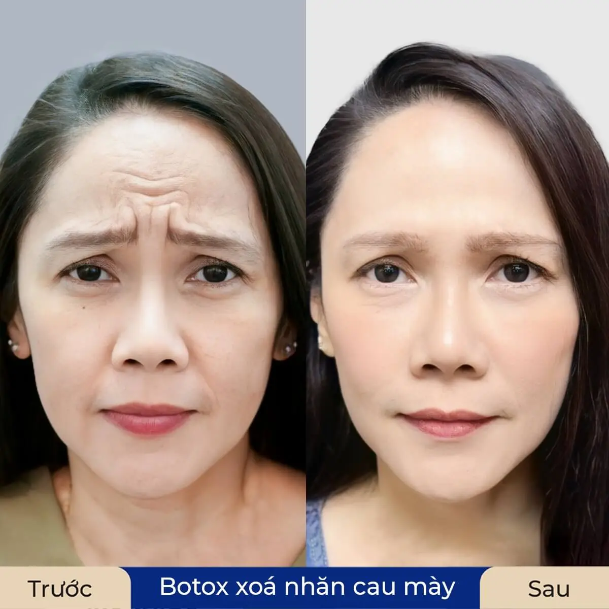 botox Làm mờ các vết chân chim đuôi mắt, nếp nhăn trán, ảnh so sánh sau khi khách hàng tiêm xóa nhăn trán