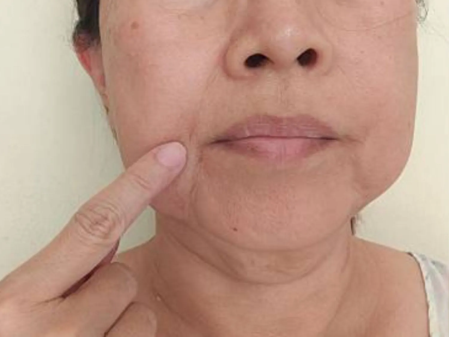 Da mặt chùng nhão rõ rệt ở tuổi trung niên