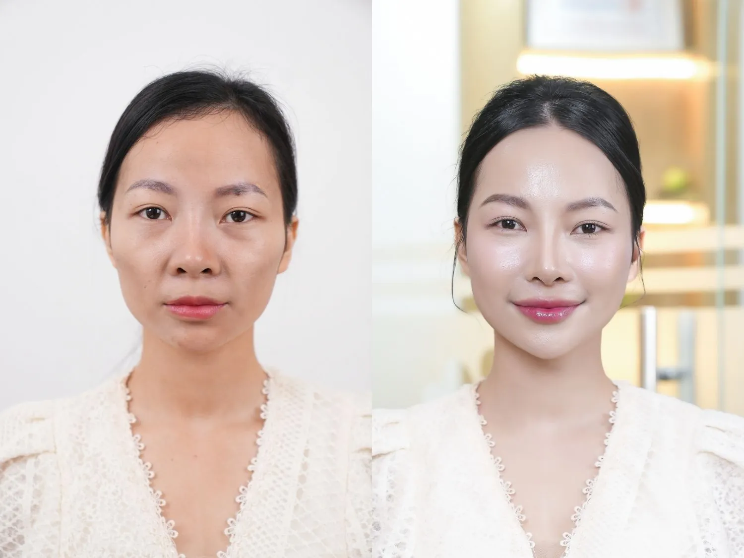 khách hàng có má hóp, rãnh cười, sau khi tiêm filler gương mặt trẻ trung hơn