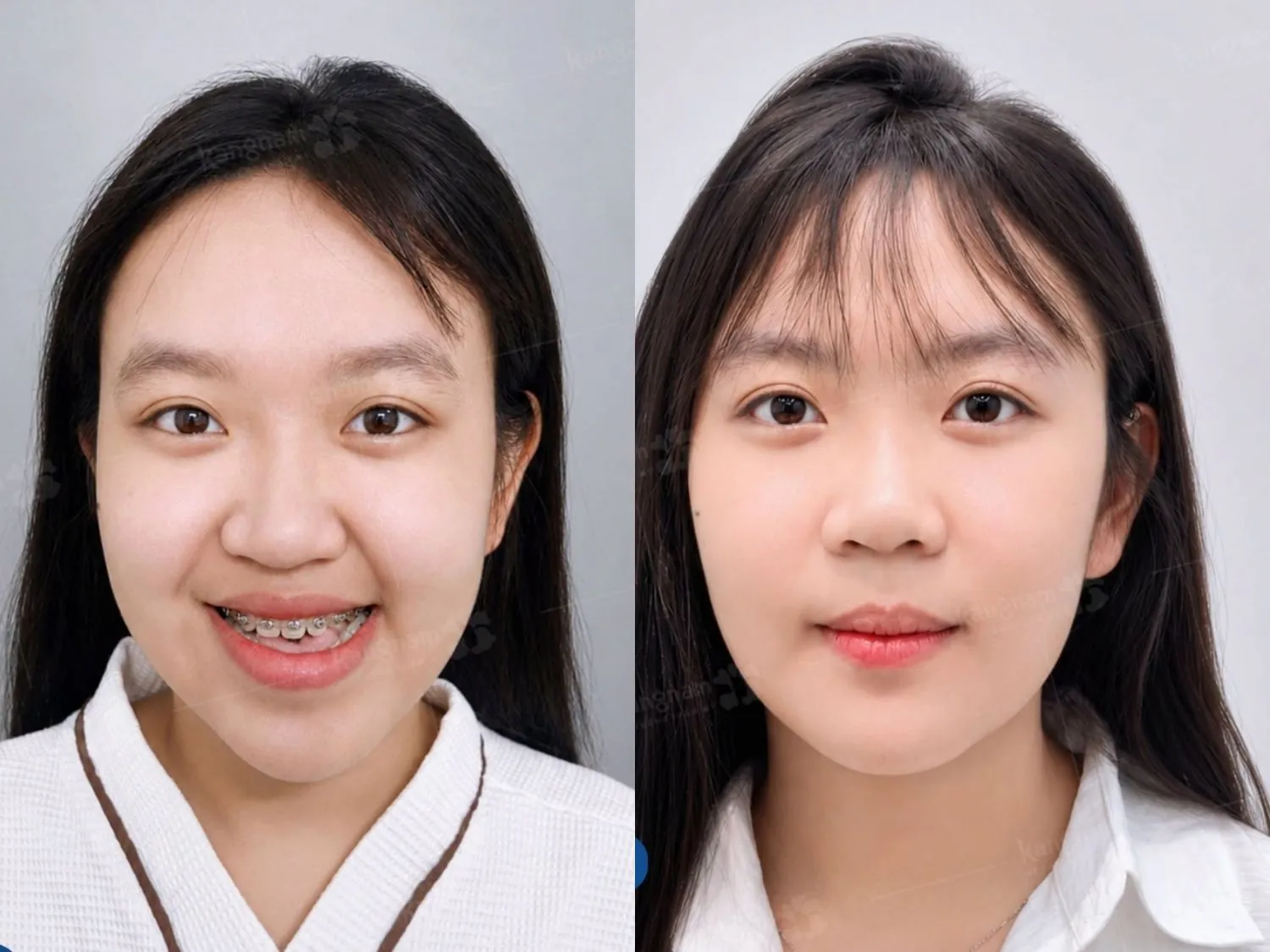Quỳnh Như bị khớp cắn ngược do cấu trúc xương. Sau 14 ngày, hàm dưới và cằm được điều chỉnh cân đối hơn