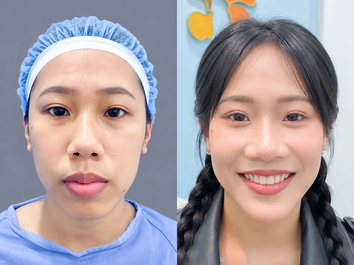 Hô do xương 100% nhưng các răng trên cung hàm mọc đều đặn