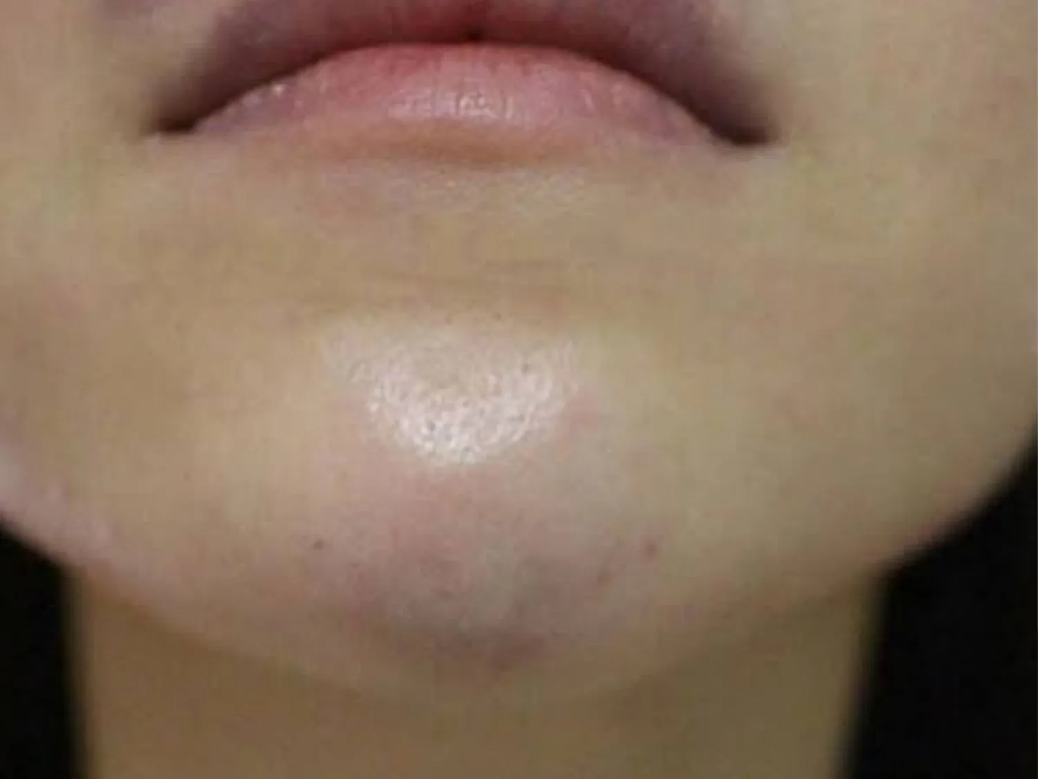 Tình trạng vón cục sau khi tiêm filler cằm