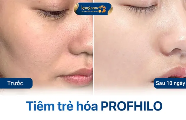 Quá trình da cải thiện sau khi tiêm profhilo tại Kangnam