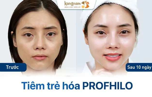 Profhilo hỗ trợ cải thiện toàn diện, phục hồi da lão hóa và thâm sạm trở nên căng bóng