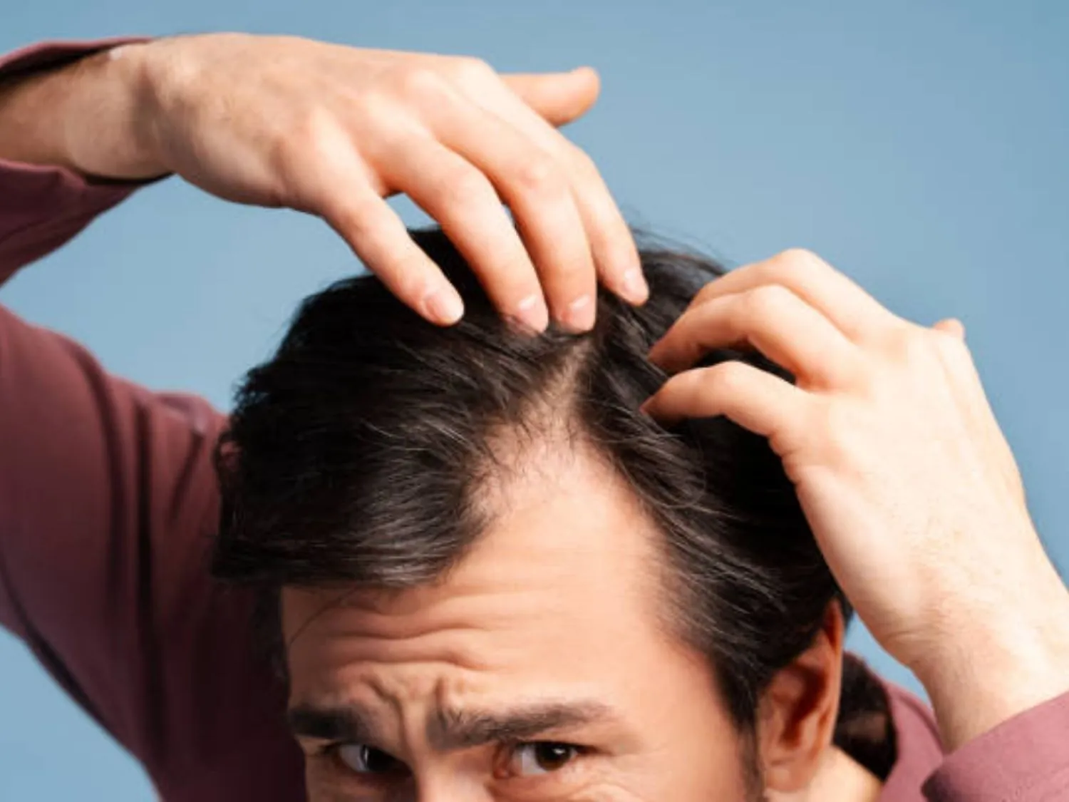 rụng tóc tạo trán hữ M ở nam giới khiến gương mặt trông già hơn tuổi thật