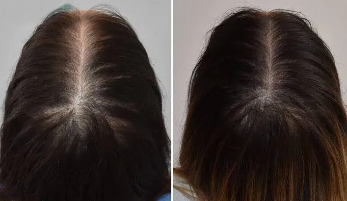 ảnh trước và sau khi trị rụng tóc bằng meso của khách hàng, tóc mọc dày và cứng hơn