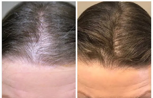khách hàng sau khi trị rụng tóc, tình trạng hói đỉnh đầu đã cải thiện đáng kể