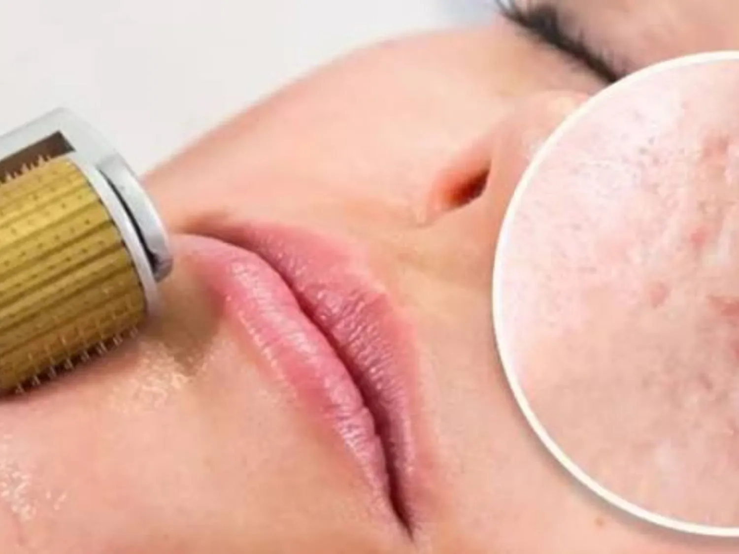 Tạo vi tổn thương bằng kim điều trị sẹo rỗ