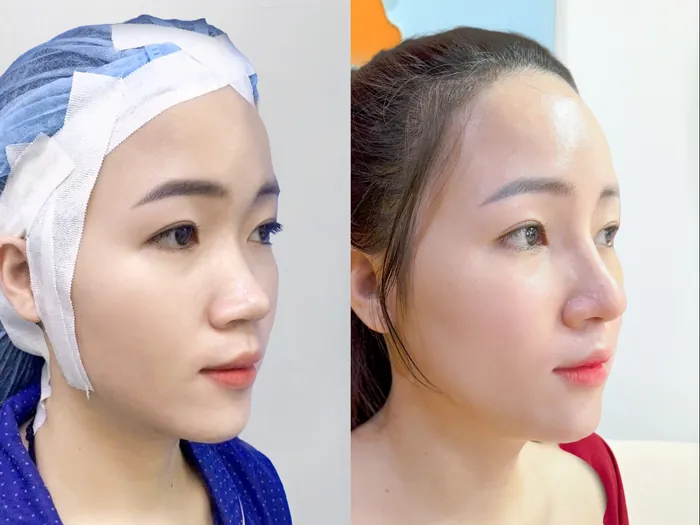 Khách nâng mũi cấu trúc sở hữu dáng mũi tự nhiên