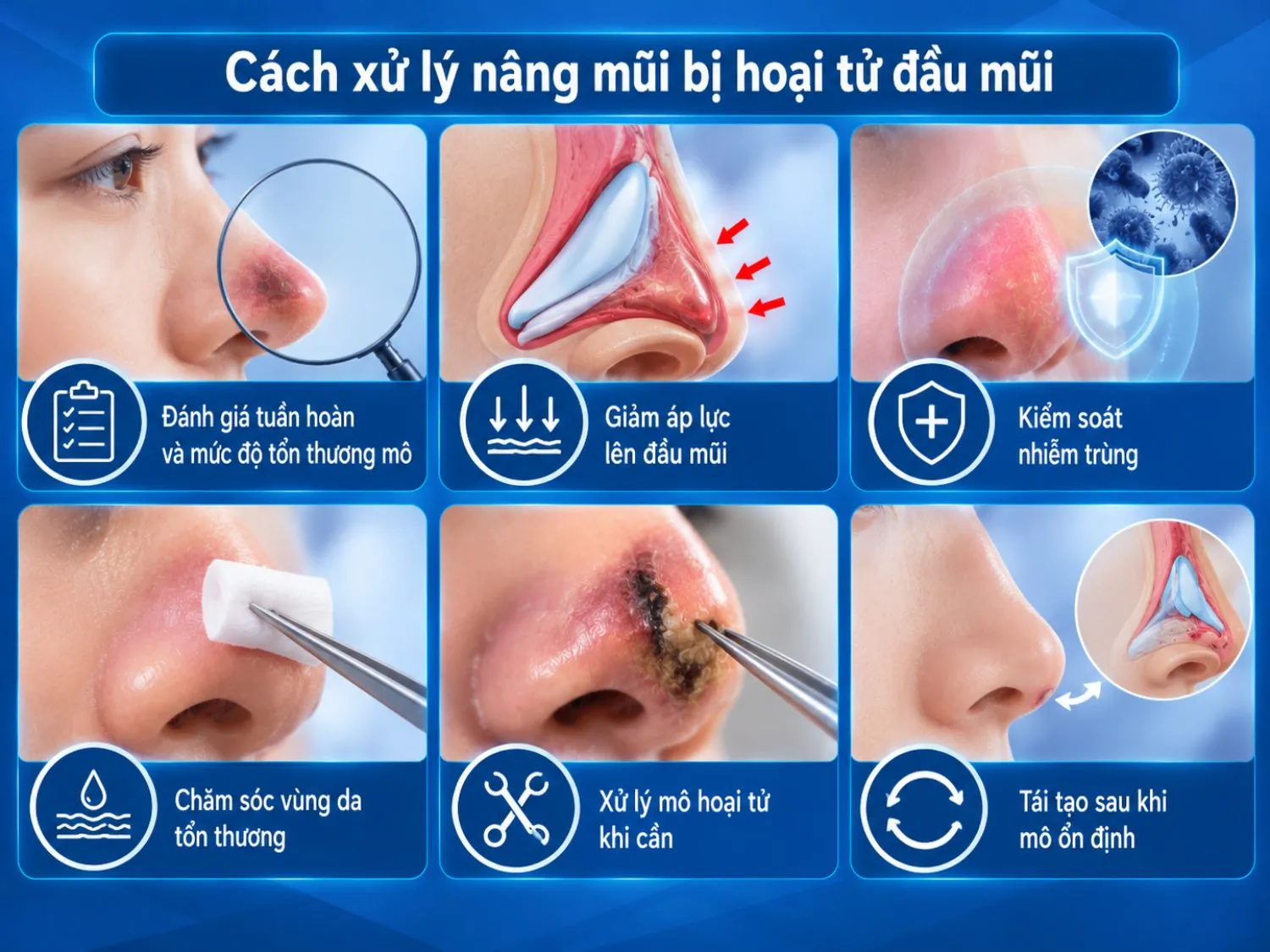 Khi nghi ngờ hoại tử đầu mũi, cần đánh giá mức độ tổn thương, giảm áp lực, kiểm soát nhiễm trùng và chăm sóc mô; việc xử lý mô hoại tử hoặc tái tạo được cân nhắc tùy tình trạng.