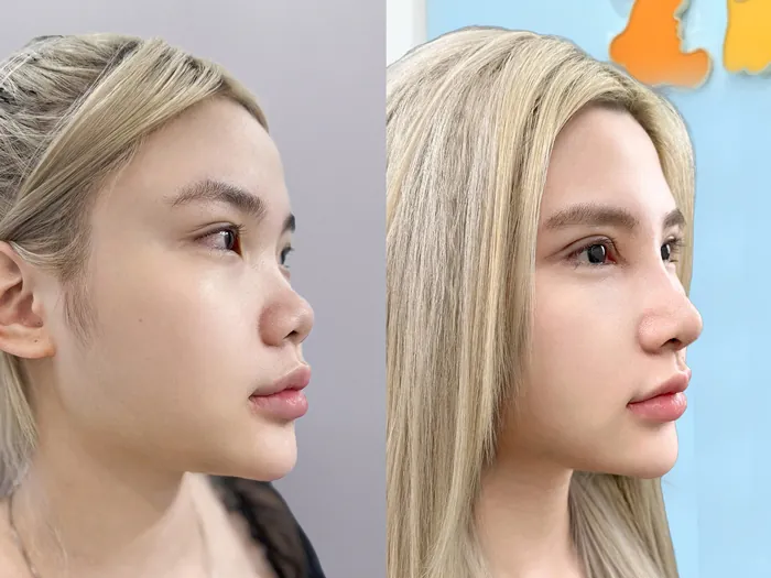 Hình ảnh trước – sau giúp khách hàng tham khảo sự thay đổi về độ cao sống mũi, đầu mũi và tổng thể dáng mũi.