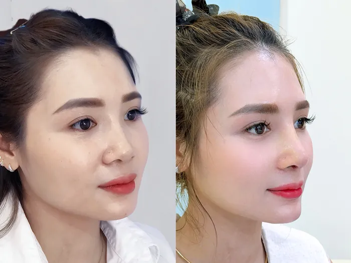 Kết quả khách hàng sau khi tái cấu trúc dáng mũi tại Kangnam