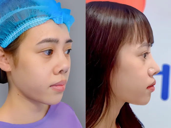 Hình ảnh trước – sau giúp tham khảo sự thay đổi về sống mũi, đầu mũi và tổng thể dáng mũi sau chỉnh sửa.