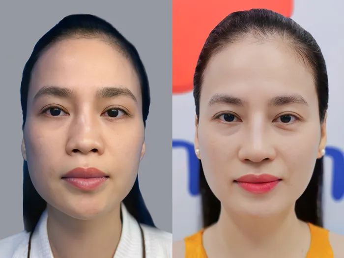 Trường hợp mũi bị tụt sụn cần phải tháo sụn thay sụn mới