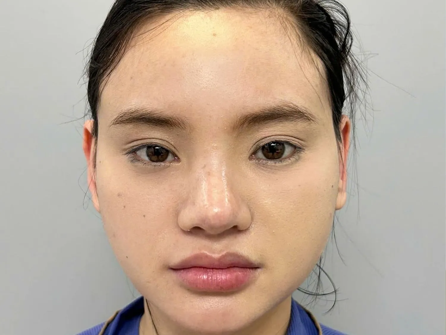 Tình trạng mũi lệch sang 1 bên