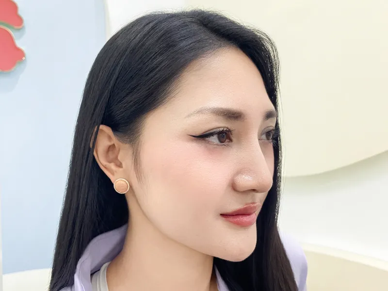 Nâng mũi cấu trúc là phương pháp can thiệp tái lập toàn bộ dáng mũi