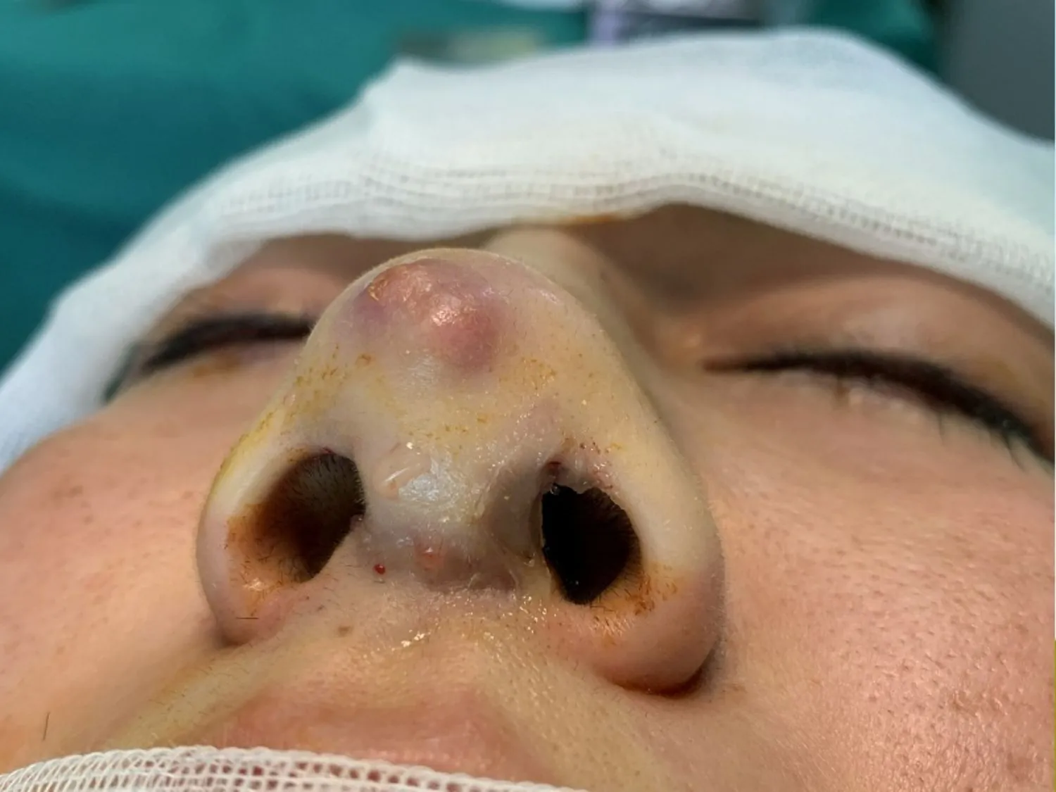 Mũi bóng đỏ, tụt sóng do dùng chất liệu không tương thích
