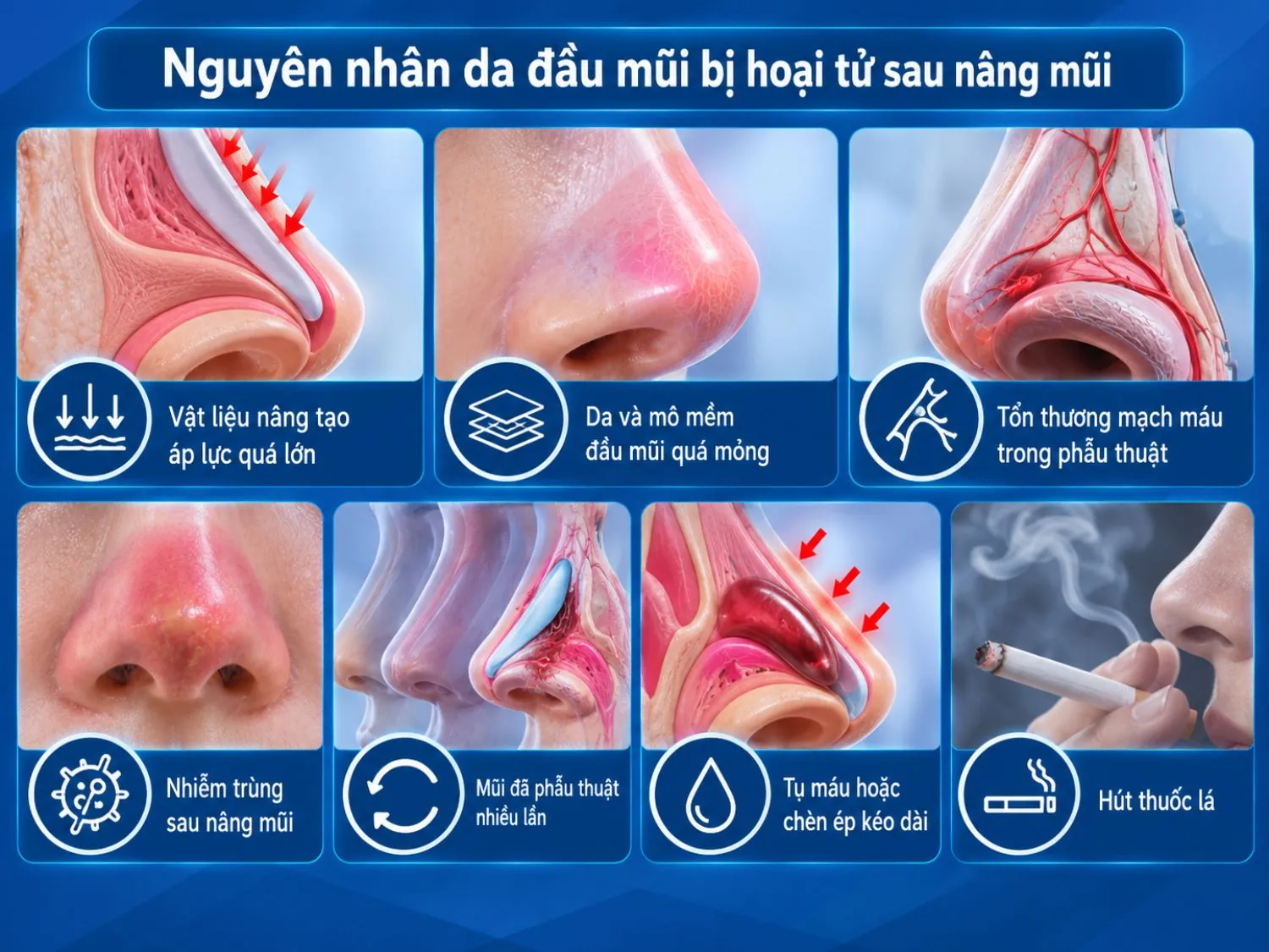 Hoại tử da đầu mũi có thể liên quan đến áp lực từ vật liệu nâng, mô quá mỏng, tổn thương mạch máu, nhiễm trùng, tụ máu kéo dài hoặc hút thuốc lá.