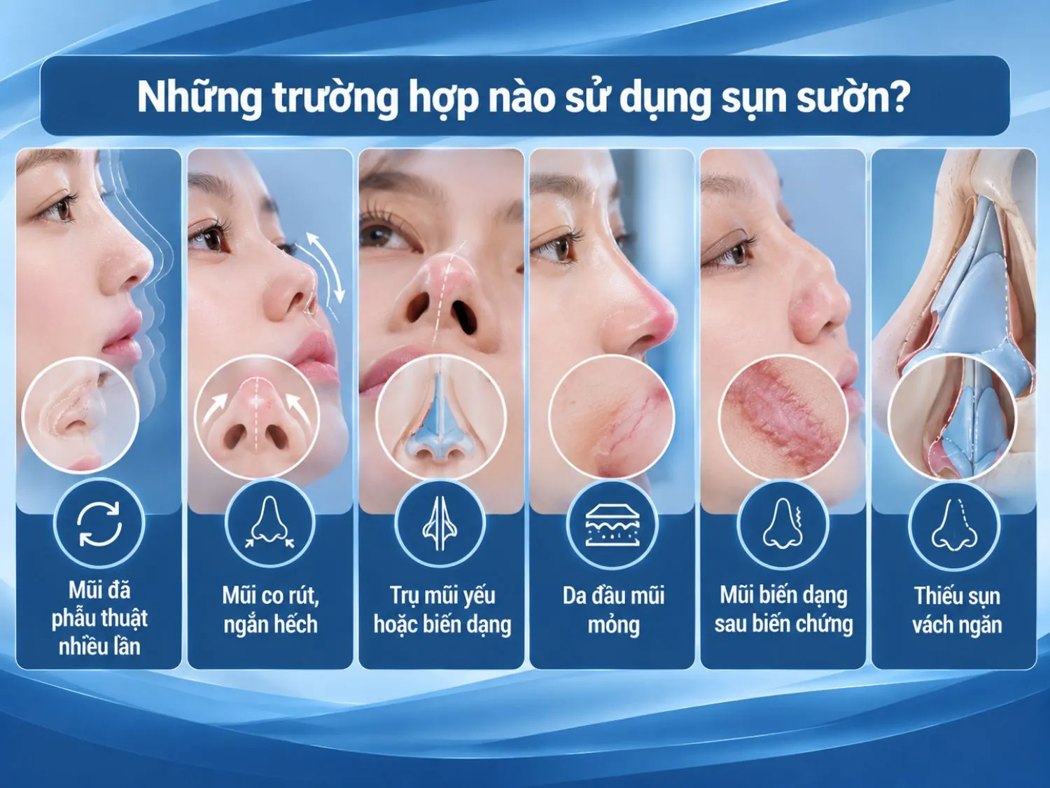 Sụn sườn có thể được cân nhắc khi mũi đã phẫu thuật nhiều lần, co rút, biến dạng, trụ mũi yếu hoặc không còn đủ sụn tự thân tại vách ngăn.
